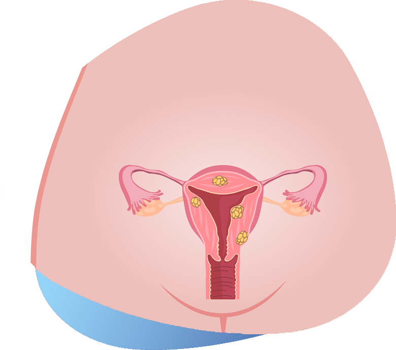 Uterine Fibroids